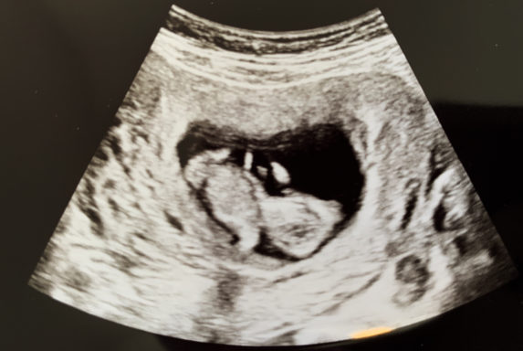 rainbow baby ultrasound