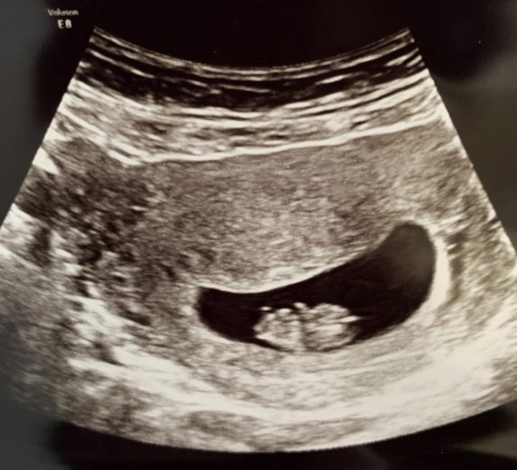 8 week ultrasound with rainbow baby